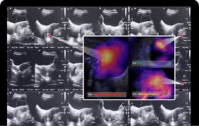 AI in ultrasound