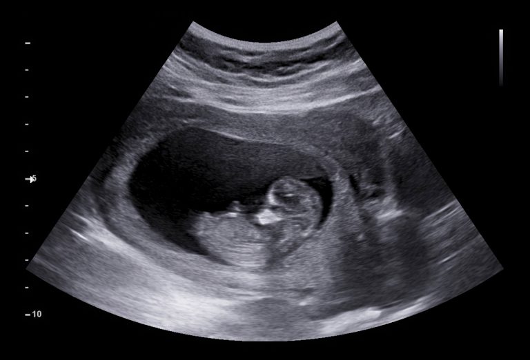 Ultrasound image